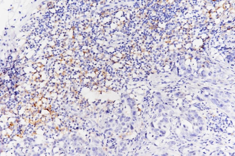 PD-L1 Expression in Lung adenocarcinoma Rabbit Anti-PD-L1/CD274