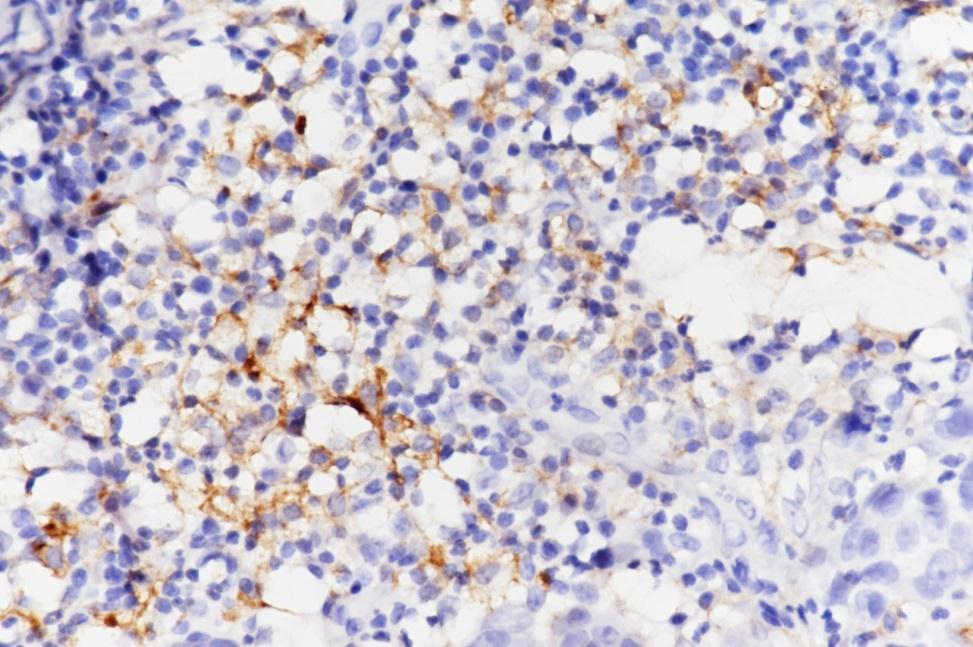 staining, 1+ Tumor and/or infiltrating immune cells 0 ( 1%), 1