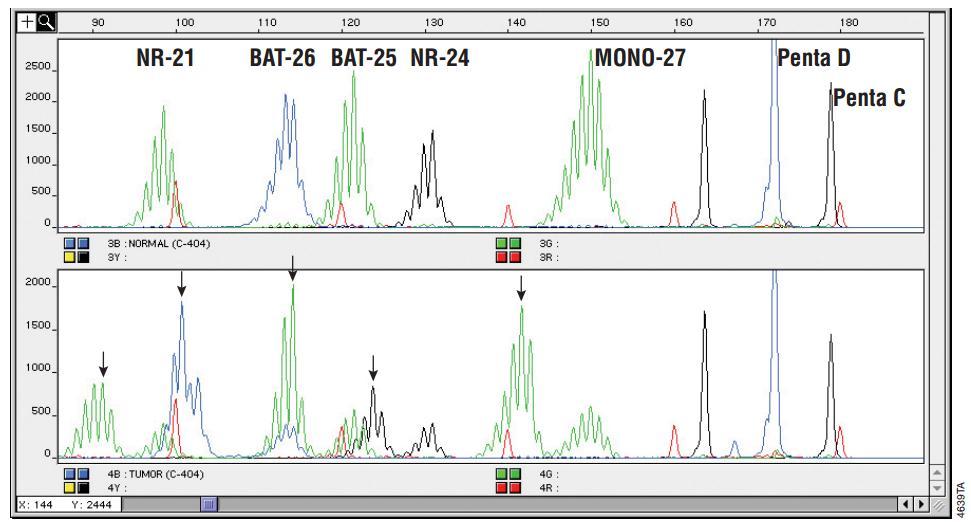 Our Results of MSI Analysis System Normal Sample MSI-H positive control sample Microsatellite instability assays using the MSI Analysis System.