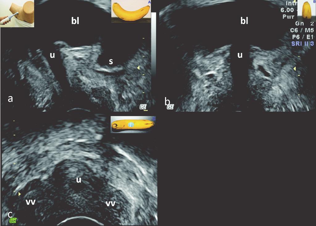 78 G. Surkont, E. Wlaźlak Fig. 1. Three plane view of a normal anterior compartment by real-time 2D PFS-TV, (a) sagittal, (b) - frontal, (c) axial.