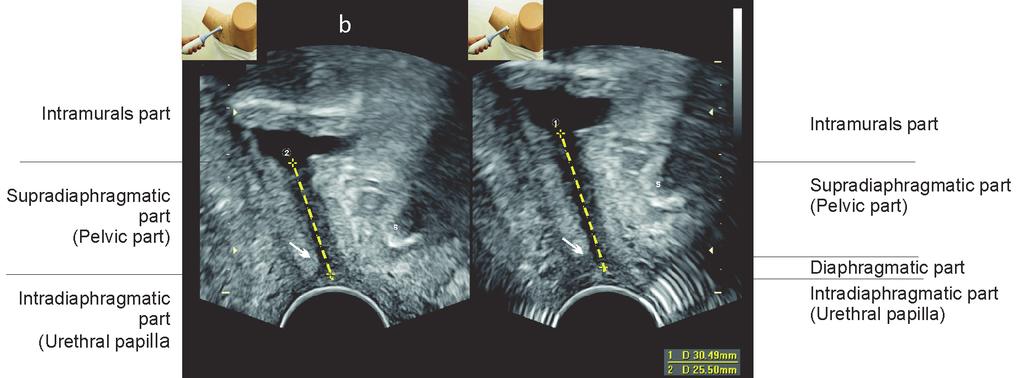 Urethral length measurement depends on the exerted pressure on the sonographic probe, (a) with pressure (diaphragmatic part is squeezed and that s why not visible), (b) without pressure (with