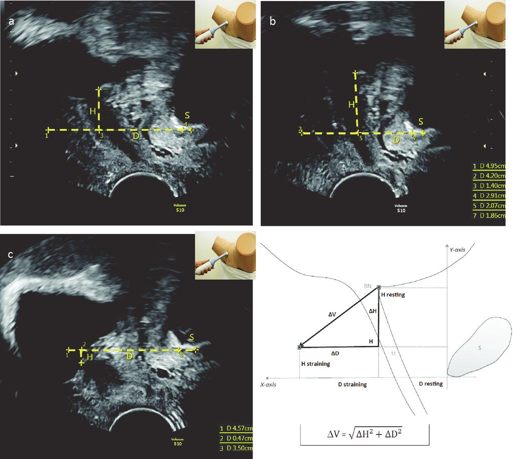 Modern methods of imaging in urogynecology when do we really need them? 79 Fig. 3. Evaluation of bladder neck position, (a) at rest, (b) during Kegel s exercise and (c) at maximal Valsalva maneuver.