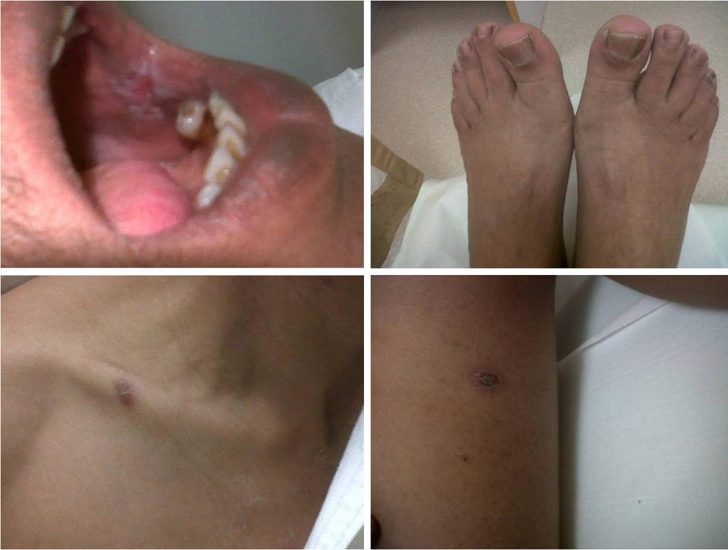 Figure 4 Hand-foot syndrome after chemoembolization with Doxorubicin. Median survival time for patients who received local therapy was 27 months (Figure 3).