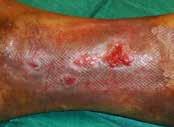effect of hyaluronic acid to improve wound bed preparation with the proteolytic action of