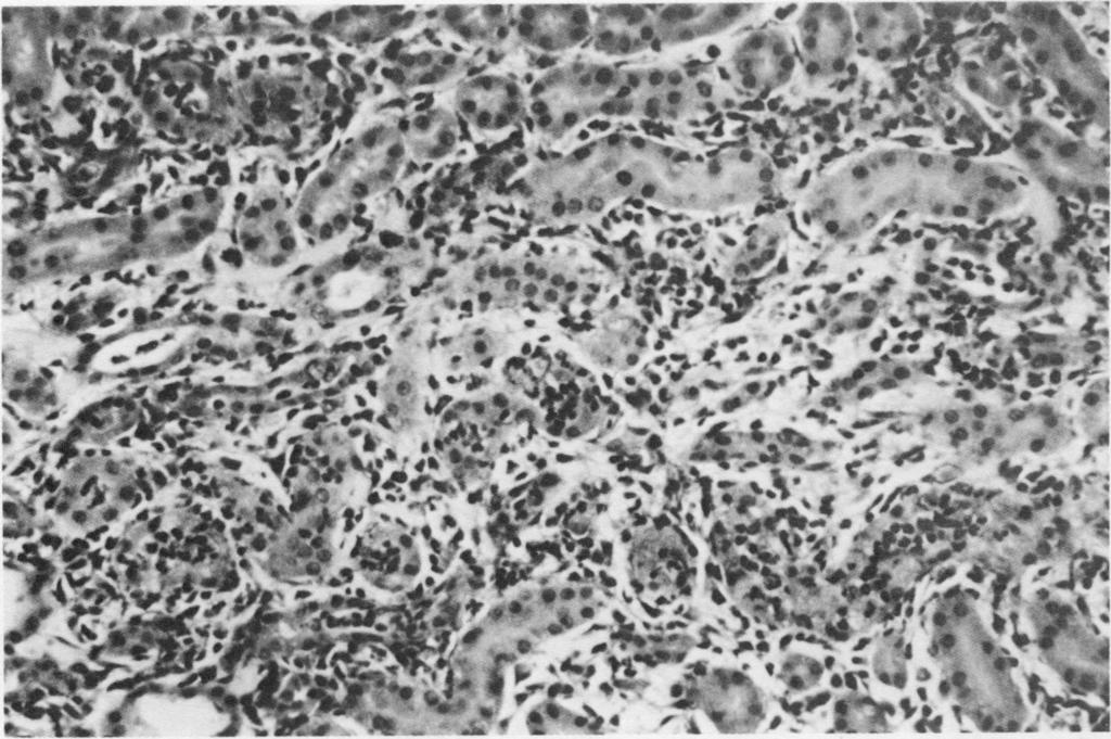 270 SULLIVAN ETAL. (= r so'~* -x.e~" A.-- X F W. FIG. 3. The kidney of a CVF-untreated rat killed on day 2. Acute inflammatory cells are present in the edematous interstitium and in tubular lumina.