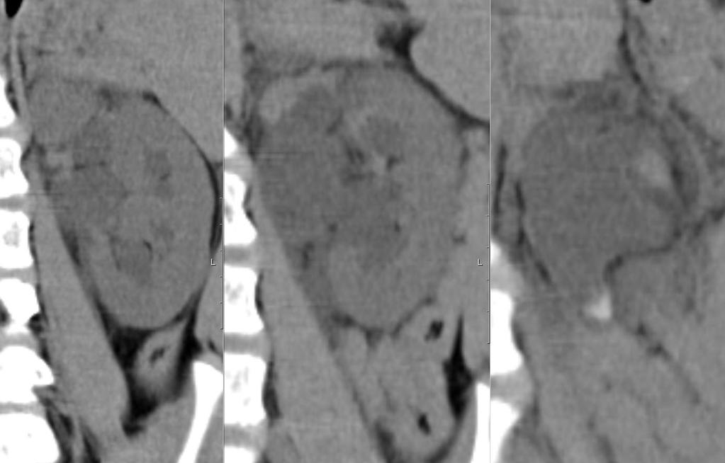 CT Secondary findings Hydronephrosis Perinephric fat