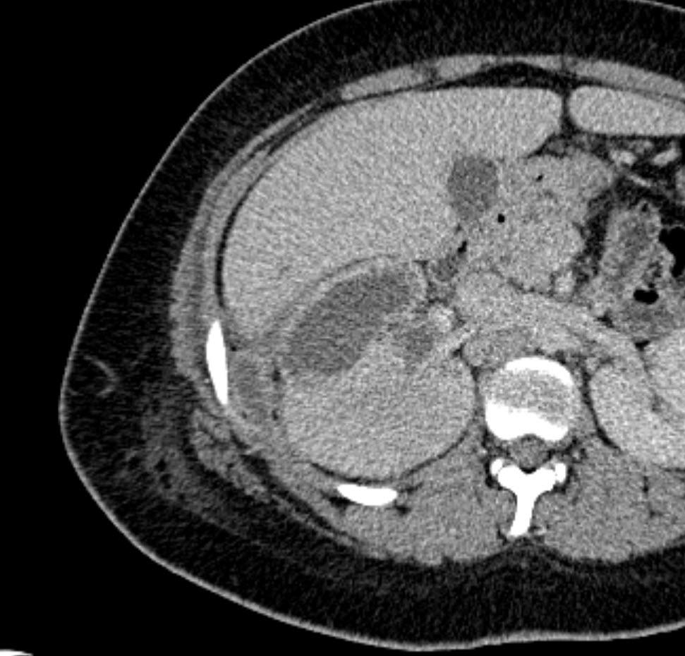 Renal abscess Rounded low-attenuation lesion(s) that fail to