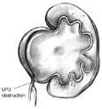 UPJ obstruction Most common urinary tract obstruction 10% of neonatal hydronephrosis Abnormal development of short segment of ureteral smooth muscle at UPJ (adynamic segment) versus extrinsic