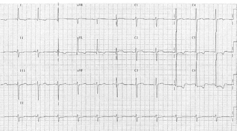EKG - Abnormal