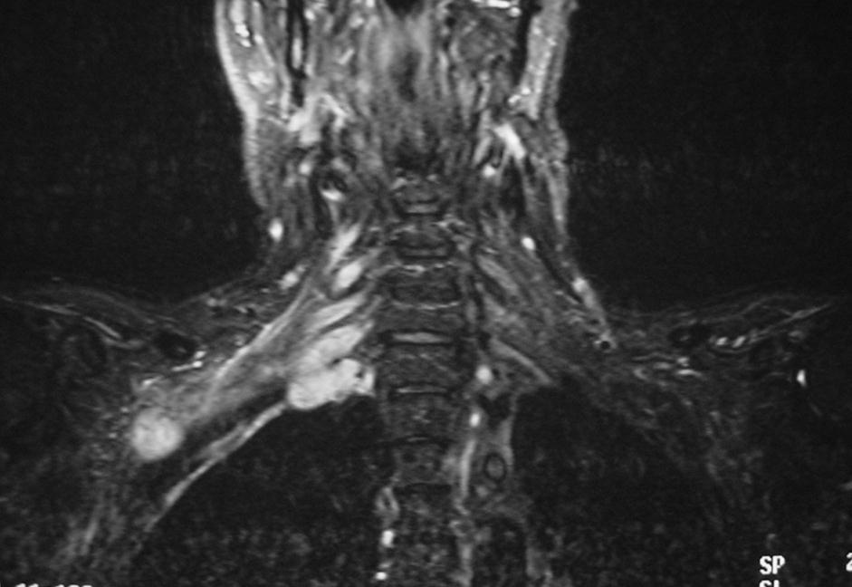 MRI of cervical