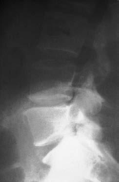 instability Degenerative spondylolisthesis grade I or II Isthmic spondylolisthesis grade I or II Pseudarthrosis of failed spondylodesis Note: Additional posterior fixation with a pedicle screw system