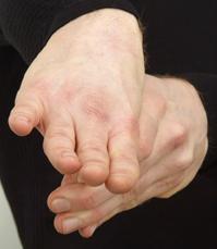 Thumb Extension 1 & 2 Area Being Stretched: Pad and Webbing of Thumb Muscle Emphasized: #1- Flexor Pollicis, Palmaris and Opponens Pollicis #2- Adductor Pollicus 1.