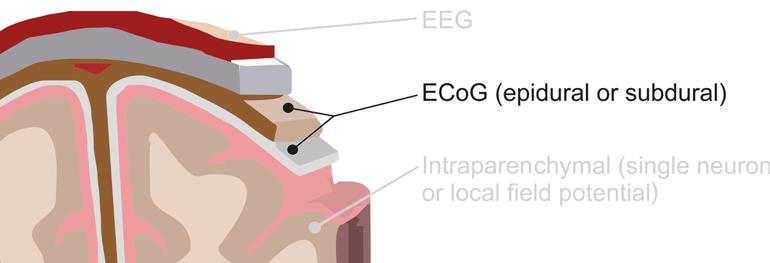Electrocorticography (ECoG)