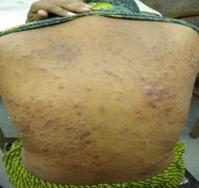 Fig: 13. Shows Papulo pustular lesions with hyperpigmentation on the the body FNAC of lymph nodes: shows non specific lymphadenitis.