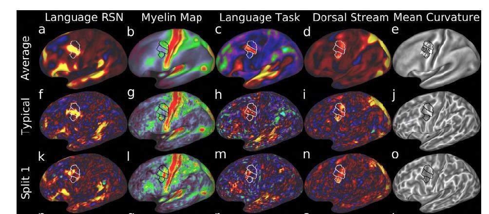 The HCP multimodal parcellation of the Human Cerebral cortex However, not all subjects brains are