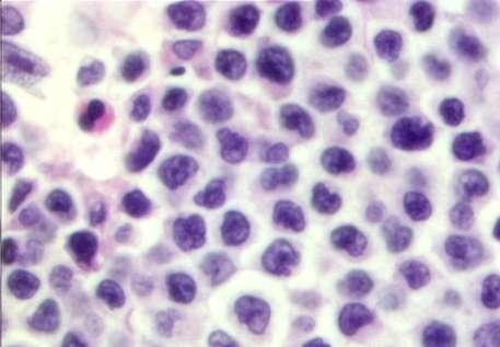 Enteropathy Associated T-cell Lymphoma (EATL) Type 2 24 cases of EATL type 2 Adjacent mucosa