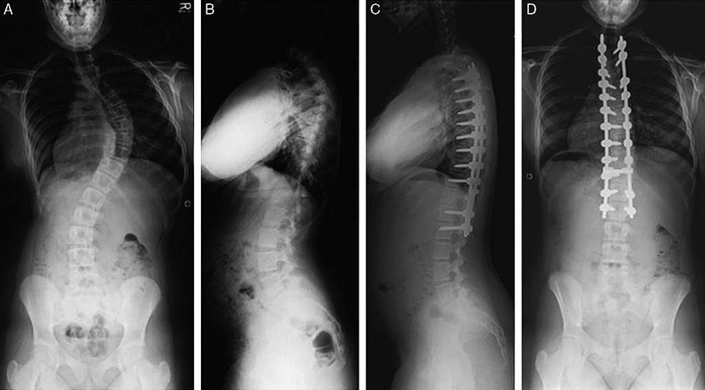 Implant and spinal mobility influence on the spinal curvature correction in adolescent idiopathic Lenke I type scoliosis 99 Introduction Spinal implant constructs have developed over years from in