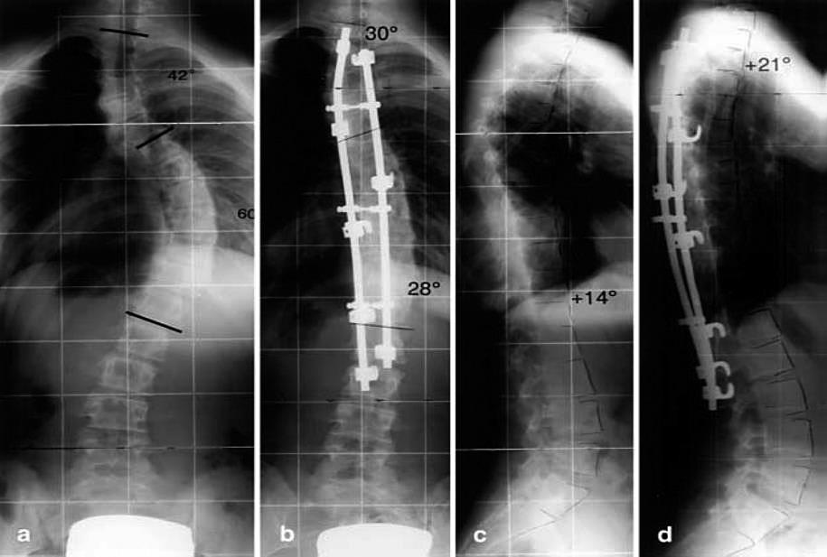 100 G. Bernotavičius, K. Saniukas, J. Vaičiulėnaitė, V. Sabaliauskas Figure 2. Preoperativespine X-rays of a patient with hooks instrumentation Figure 3.
