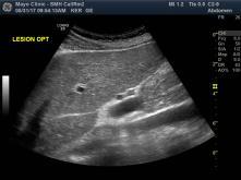 (1) Performance standardization of two ultrasound systems for US-guided RF ablation practice
