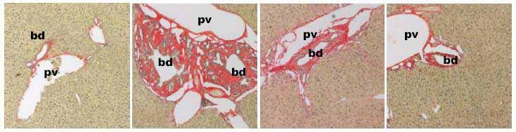 Sirius Red norudca Reverses Biliary Fibrosis in Mdr2 -/- (KO) Mice WT Hydroxyproline (μg/g Liver) 450 400 350 300 250 200 150 100