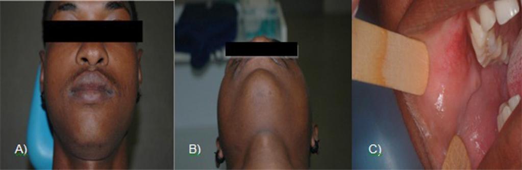 293 RSBO. 2013 Jul-Sep;10(3):289-94 After 8 post-surgery months, the patient exhibited no signs of lesion relapse and good face symmetry (figure 6).