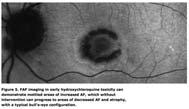 Lipofuscin Biomarker evident in normal aging and chronic disease Accumulates throughout life in RPE Believed to be toxic and interfere with normal cell function Evident in ocular disease before