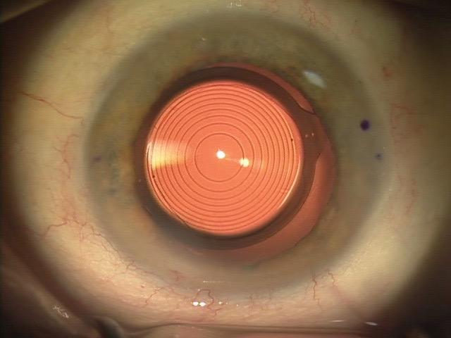 Goals of Cataract Surgery Goals of Cataract Surgery Primary - Remove cataract safely and efficiently Visual demands and postoperative expectations may vary, but every