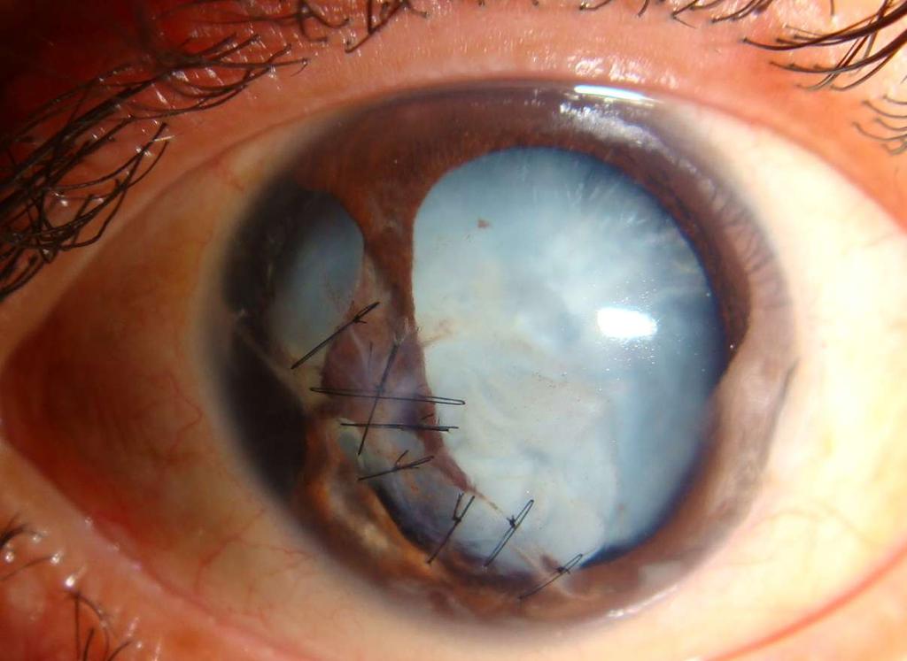Traumatic Corneal Injury + Cataract Fix the cataract first, address corneal