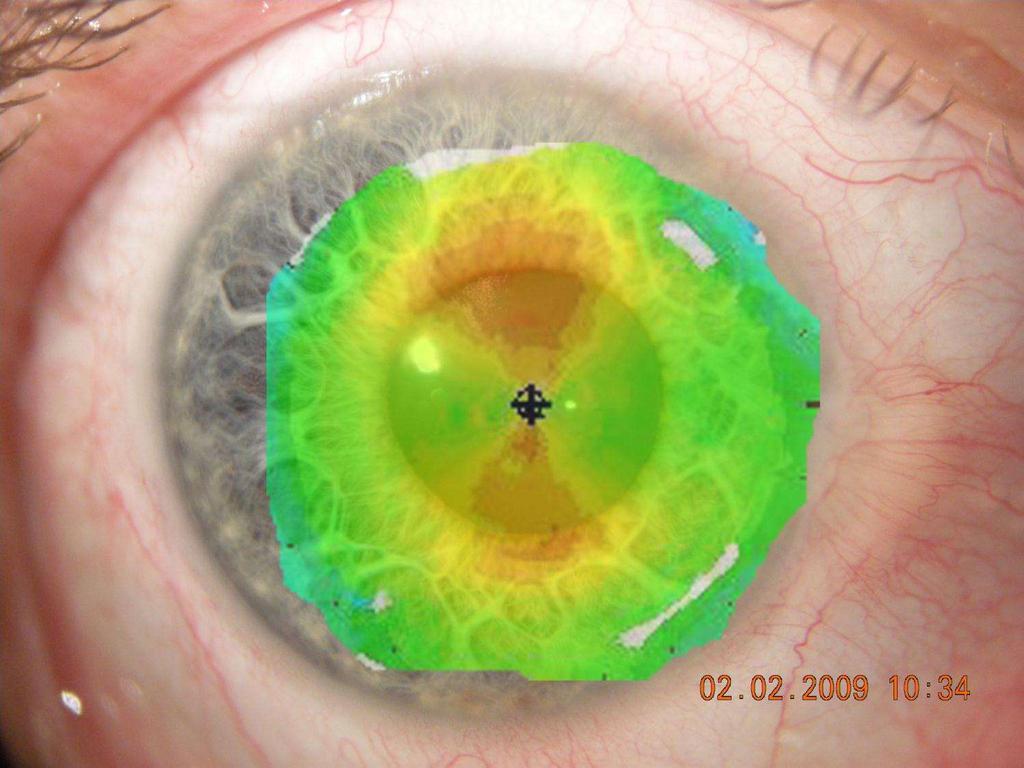 If the central cornea is relatively
