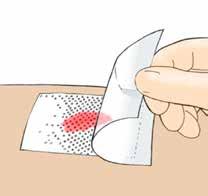 Cover with a secondary dressing of choice which may be an absorbent pad or film dressing. Silflex may be kept in place for up to 14 days depending on the wound condition.