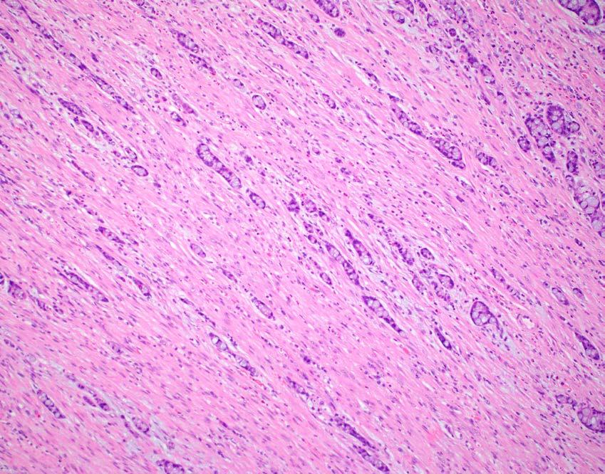 Goblet Cell Carcinoid Rarely forms a mass lesion Usually infiltrates the
