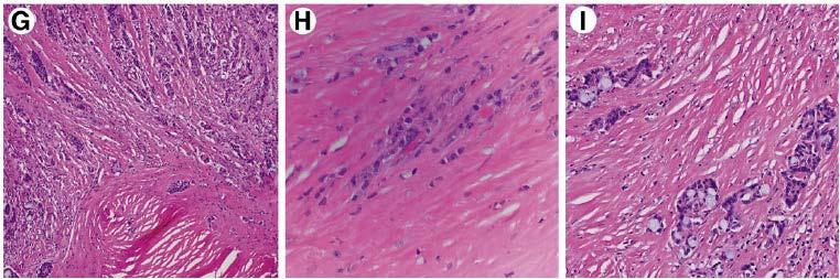 Peritumoral stromal desmoplasia that replaces the smooth muscle