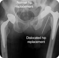 Preventing Dislocations What is a total hip dislocation?