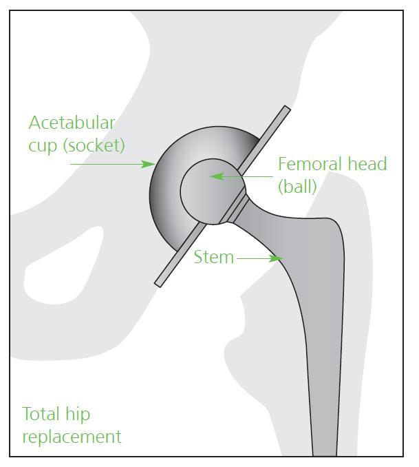 Total Hip Replacement Surgery Information for Patients having Total Hip Replacement Surgery Hello!