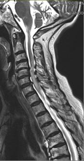 Journal of Spine Surgery, Vol 3, No 2 June 2017 213 Results Figure 1 Case #12: static MRI was classified as C4-C5 2ap, C5-C6 2ap, C6-C7 2ap.