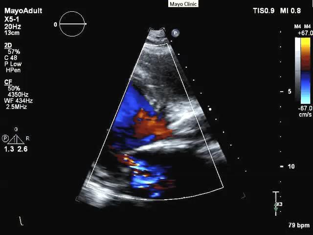89 year old with TAVR 4 year follow-up 2018 MFMER