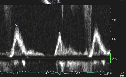 71 year old woman with HR 45 BPM & LAVI