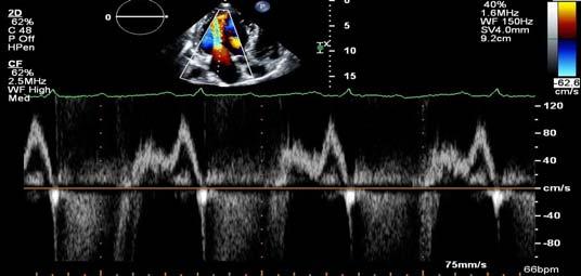 67 yo man with ischemic CM and