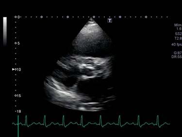II/VI SEM LSB Echocardiogram Parasternal