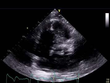 Echocardiogram Parasternal Short Axis
