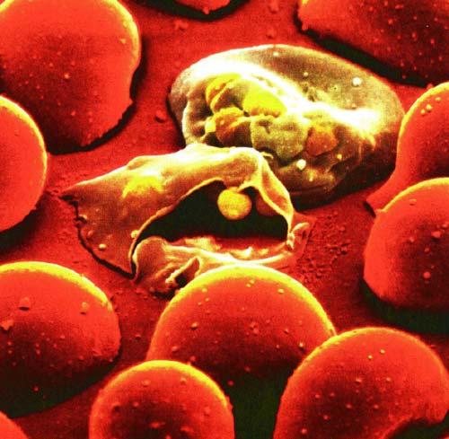 Red blood cells in the process of being destroyed by Plasmodium spp.