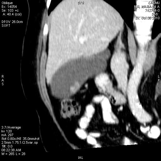 It also has its role in post operative controls, assessing tumor relapse. Figure 1. In situ Carcinoma (polypoid form). Abdomen CT with oral contrast and i/v.