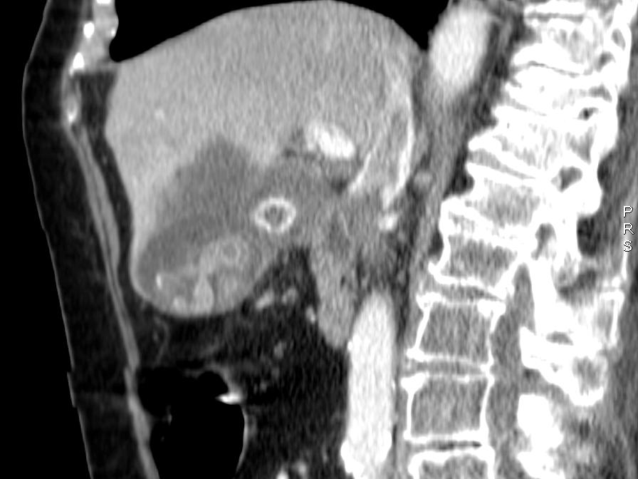 We have presented diverse cases studied by CT and with anatomopathological confirmation in order to revise CT findings associated to this pathology. Figure 5. Infiltrating carcinoma.