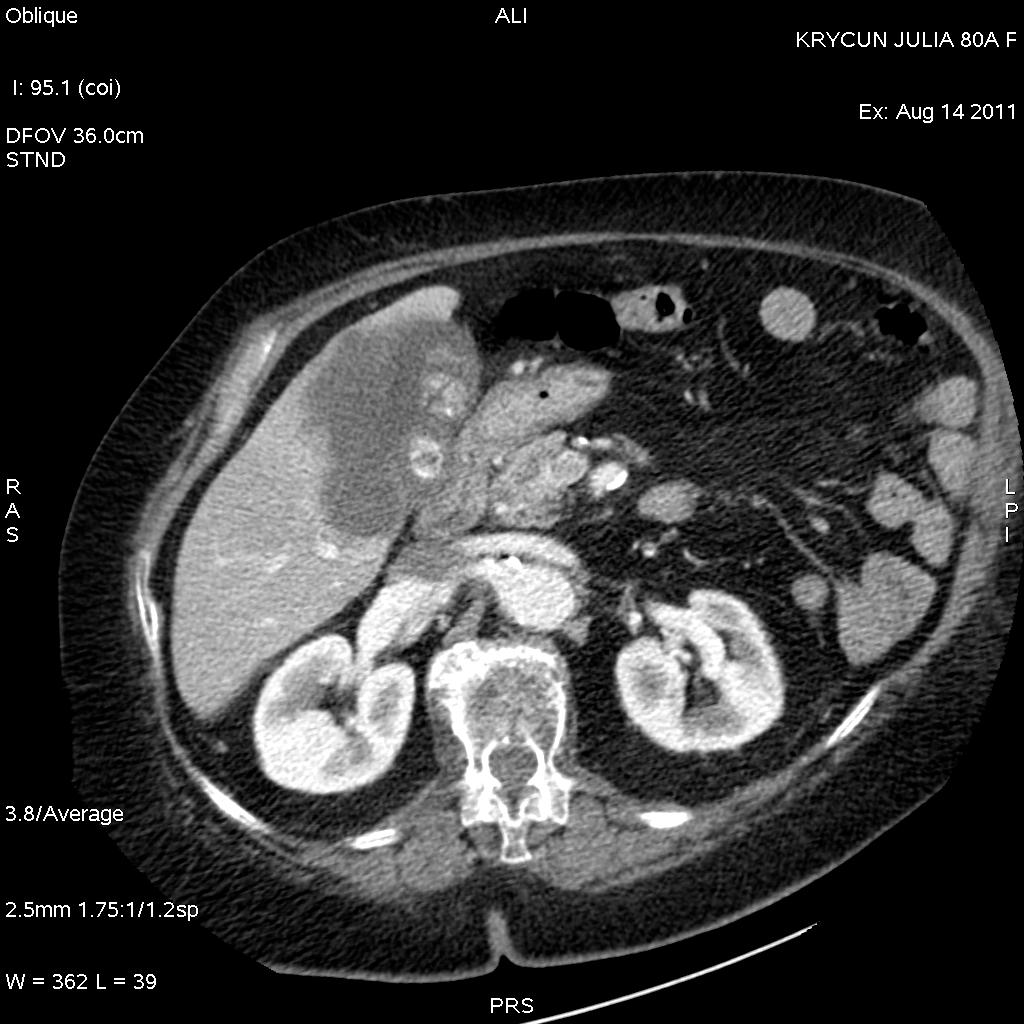 A solid and hypo dense process in relation to the bottom wall of the gallbladder is observed, with extra luminal growth which infiltrates the liver (black arrow), intra luminal, vegetative, with