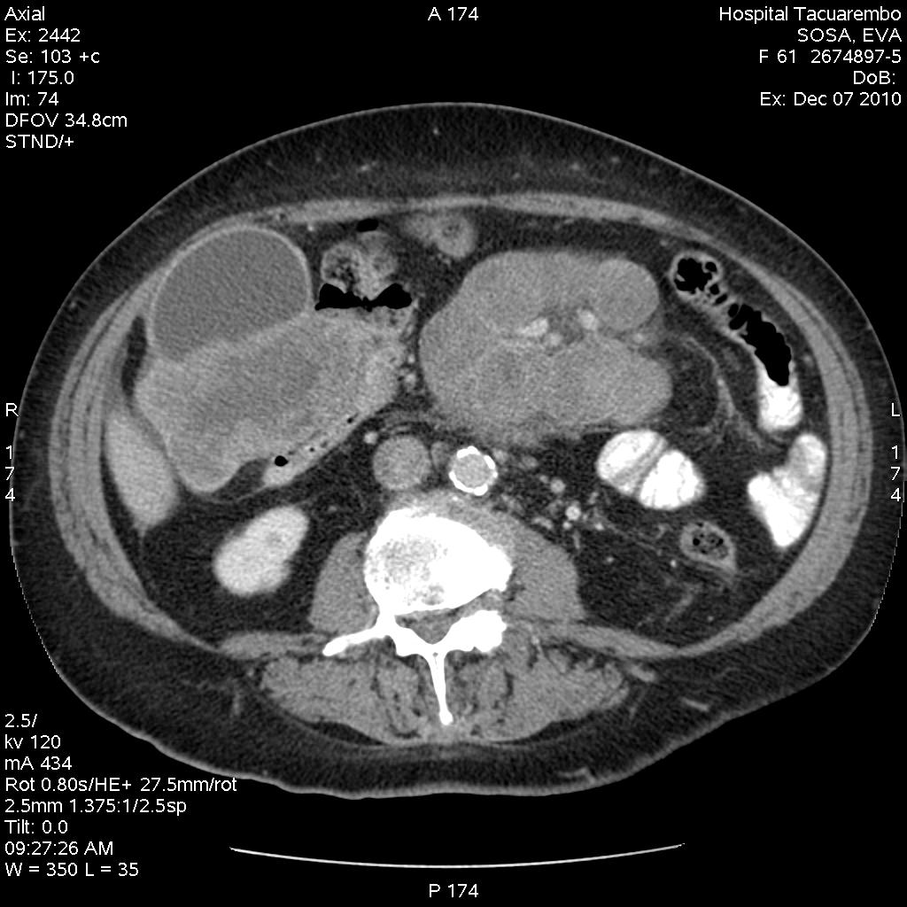 stenosis syndrome. Peritoneum nodules adjacent to the gallbladder bottom (white arrow). Figure 8.
