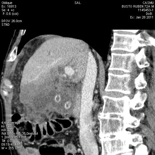 6 REVISTA DE IMAGENOLOGIA- EII / Vol. XVI / Num. 2 Figure 9. Infiltrating carcinoma, with multiple hepatic metastases. Abdomen CT with oral contrast and i/v.