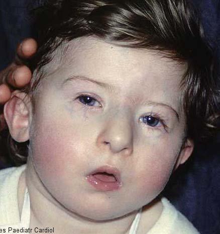 Imprinting & Chromosome 15 Angelman Syndrome Prader-Willi Syndrome