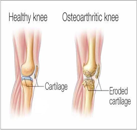 OSTEOARTHRITIS mechanical stress on the joint and low grade inflammation breakdown