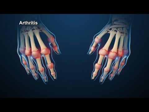 RHEUMATOID ARTHRITIS autoimmune disease in which the body s immune system which normally protects