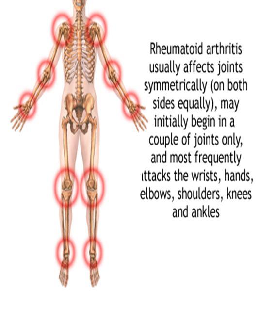 PARTS AFFECTED Rheumatoid arthritis can affect many non joint structures, including: